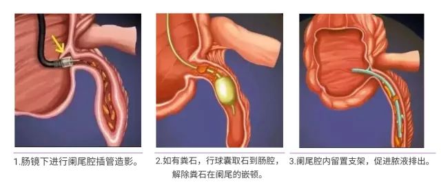 目前认为,阑尾炎多由粪石感染引起.